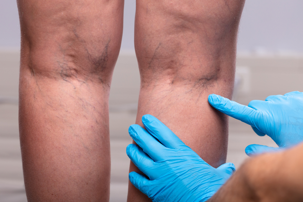 Frequently Asked Questions About Spider Vein Treatments