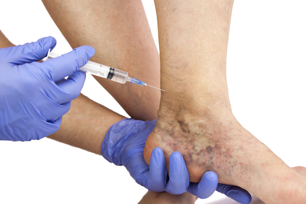 doctor performing varicose Vein treatment
