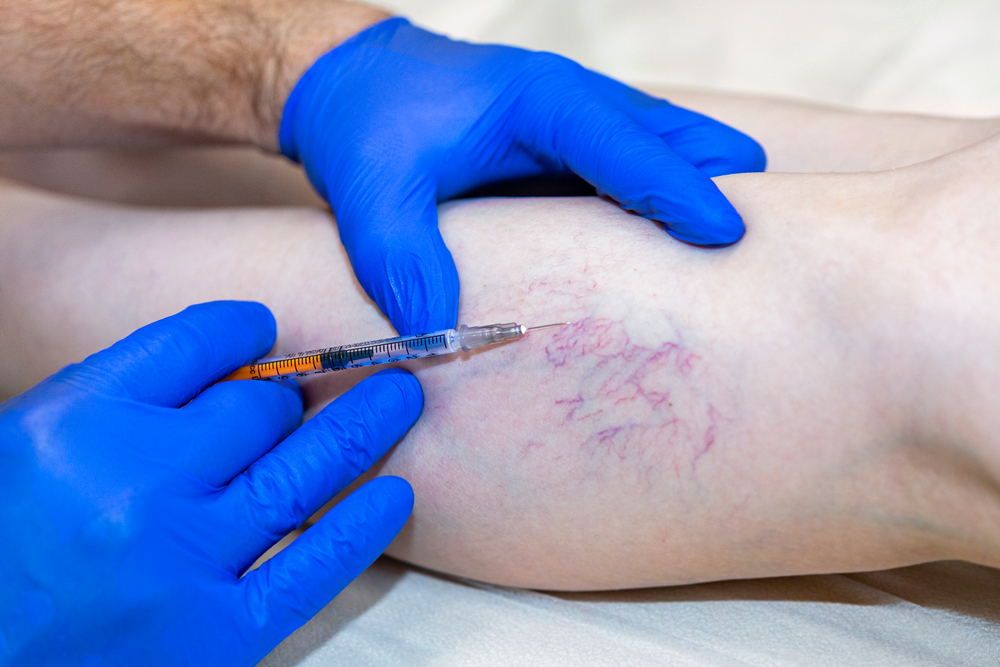 Laser,Treatment,Of,Varicose,Veins,On,The,Leg,With,Anesthesia