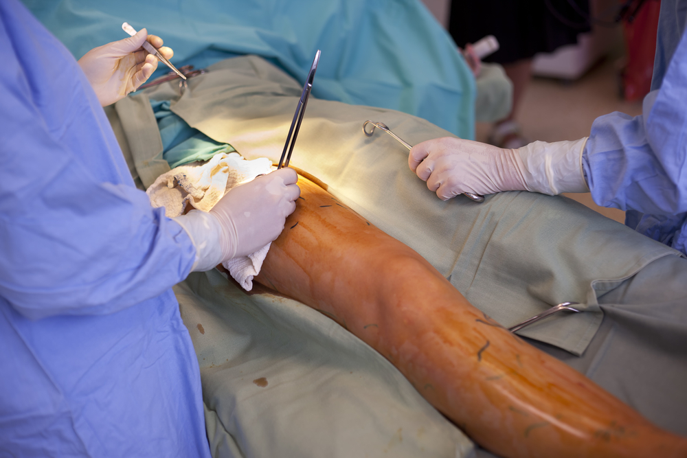 Compression stockings for varicose veins: are they effective?: Texas  Vascular Institute: Varicose Vein Specialists