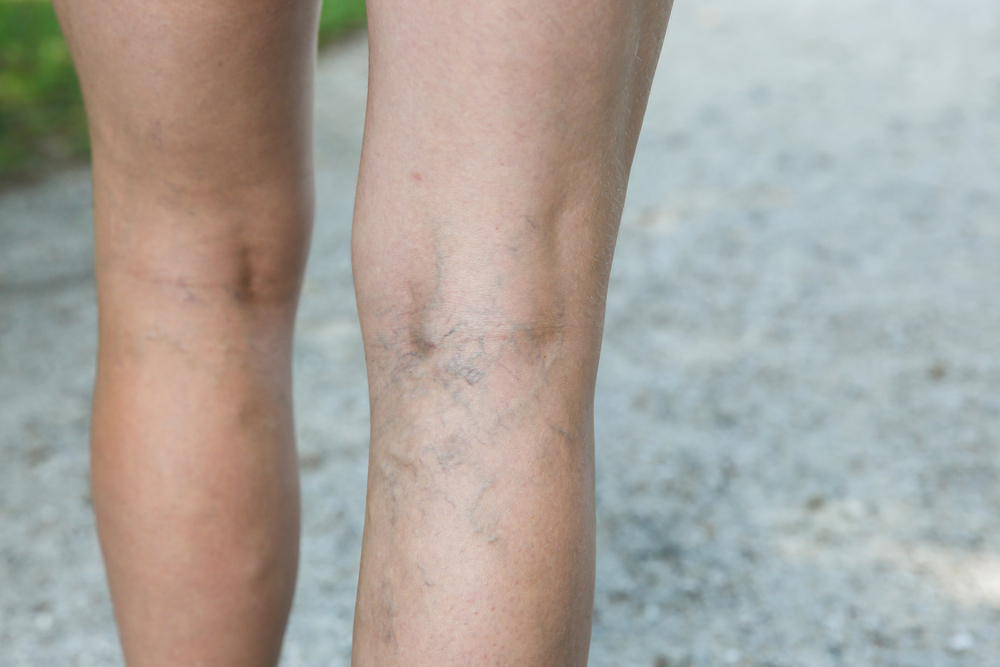 What is Venous Insufficiency? - VeinSolutions Austin