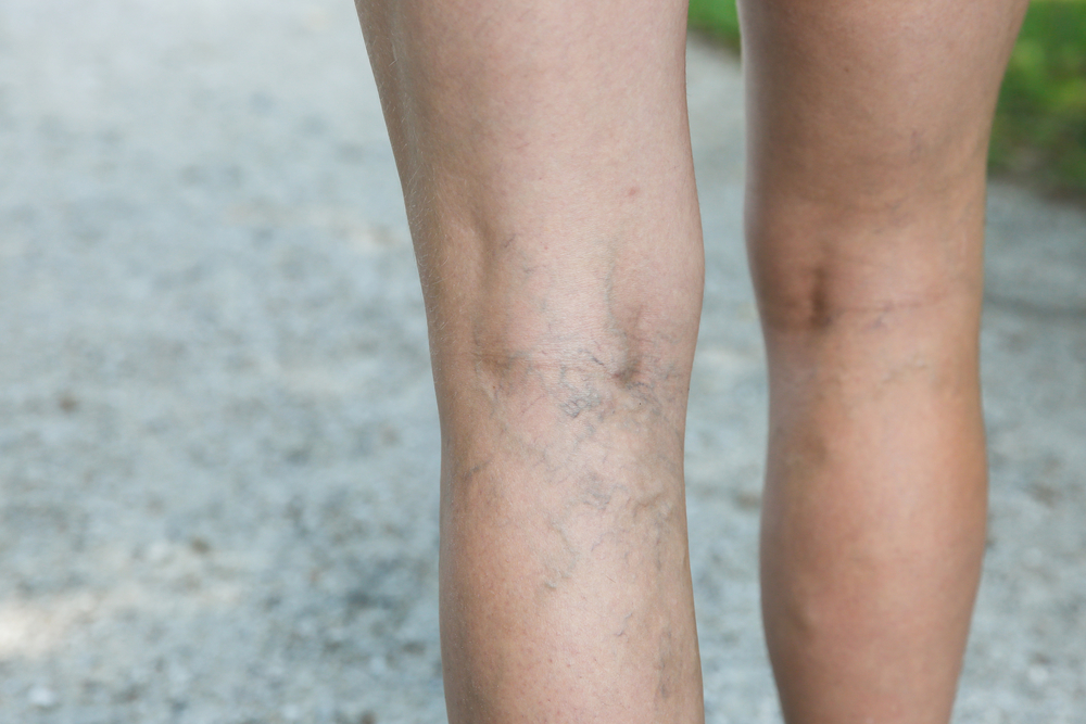 VenaSeal - New Varicose Vein Treatment Approved By FDA