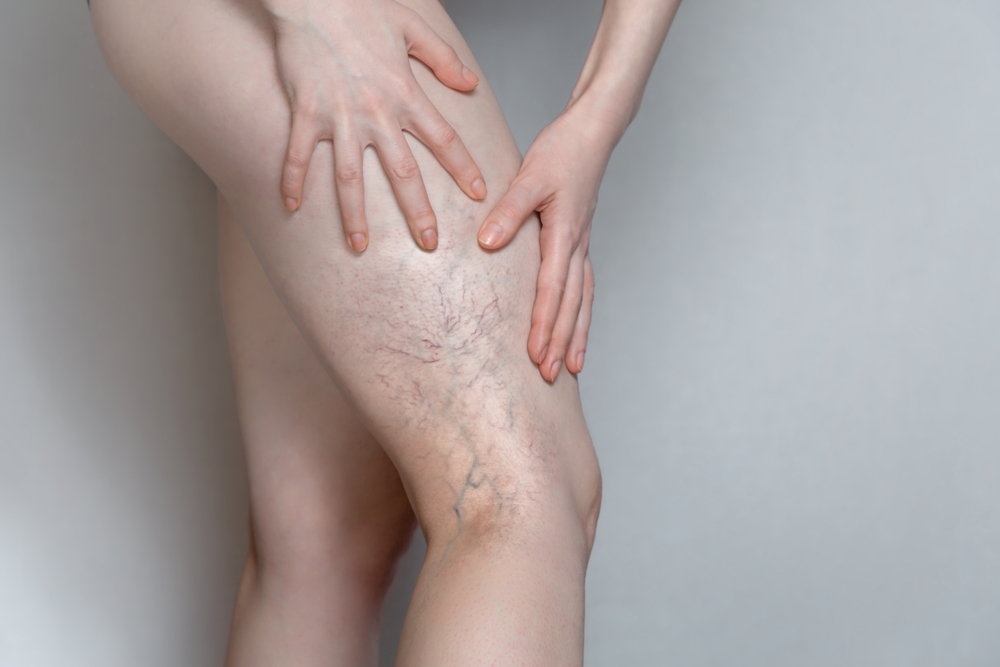 Deep Vein Thrombosis vs. Varicose Veins: What's the Difference?