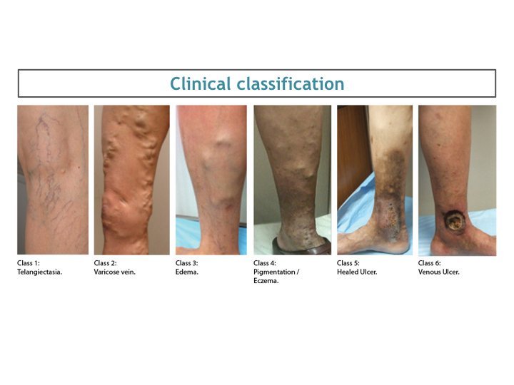 dermatitis pigmentation ankle and leg are dangers of varicose veins