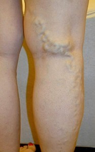blue bulging leg veins that are varicose veins
