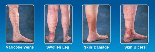 leg vein disease