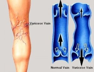 varicose veins and valve reflux