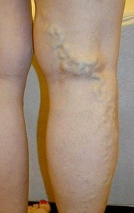 Leg Varicose Veins Treatments Austin