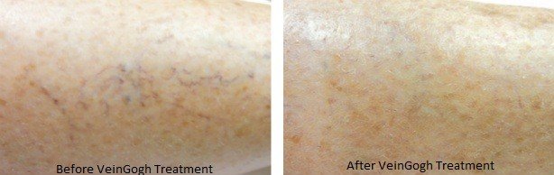 Before & After image of facial skin following VeinGogh vein treatment