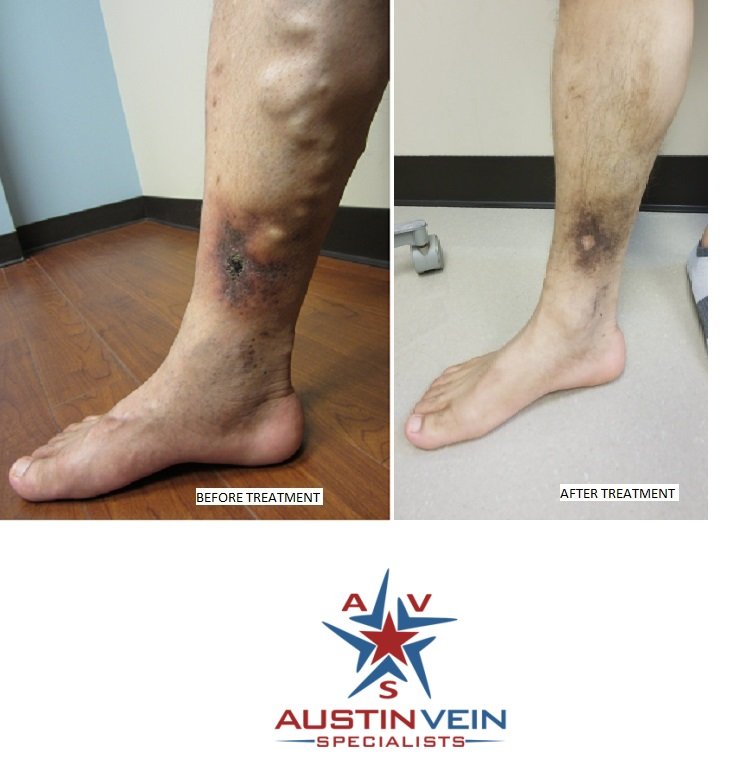 Venous Ulcer Therapy, Ankle And Leg Wounds