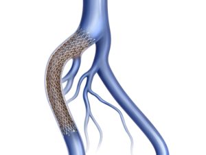 iliac vein stent May Thurner Syndrome