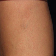 Photos of before and after spider vein treatments