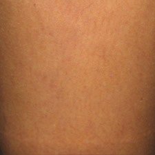 Spider Veins Treatments Before and After