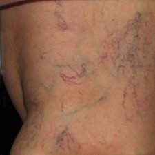 Before and After Spider Veins Treatment Photographs