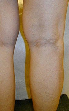 Before and After vein treatment photos