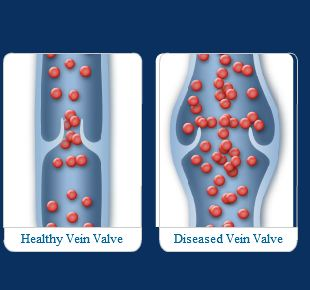 Varicose veins and blood clots