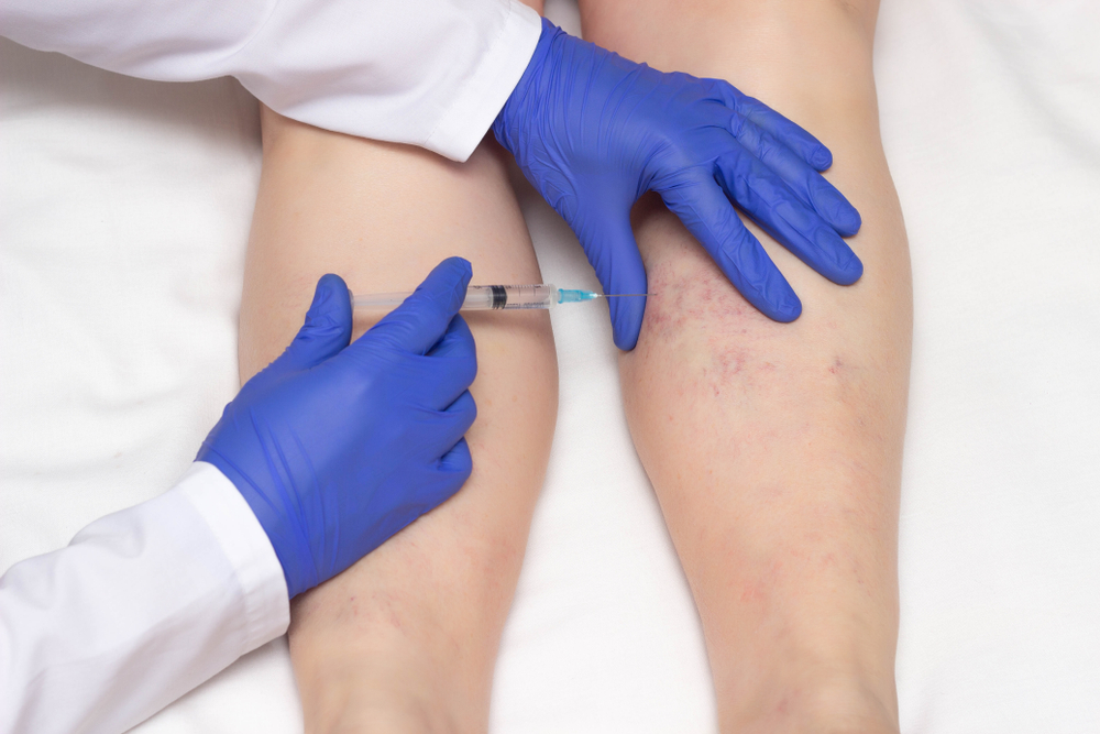 Doctor,In,Medical,Gloves,Injects,Sclerotherapy,Procedure,On,The,Legs