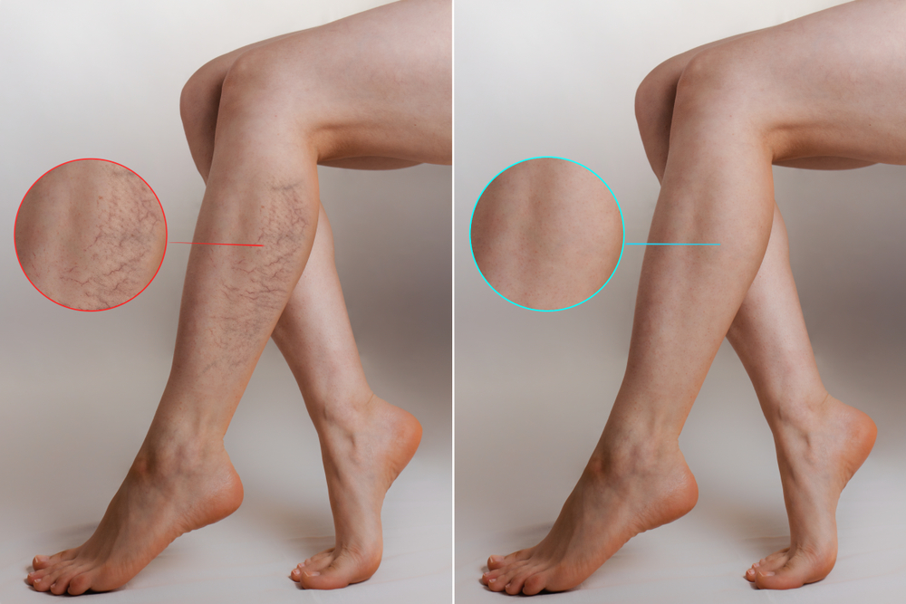 Endovenous Laser Therapy, Spider Vein Treatment