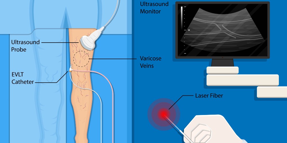 endovenous vein ablation treatments