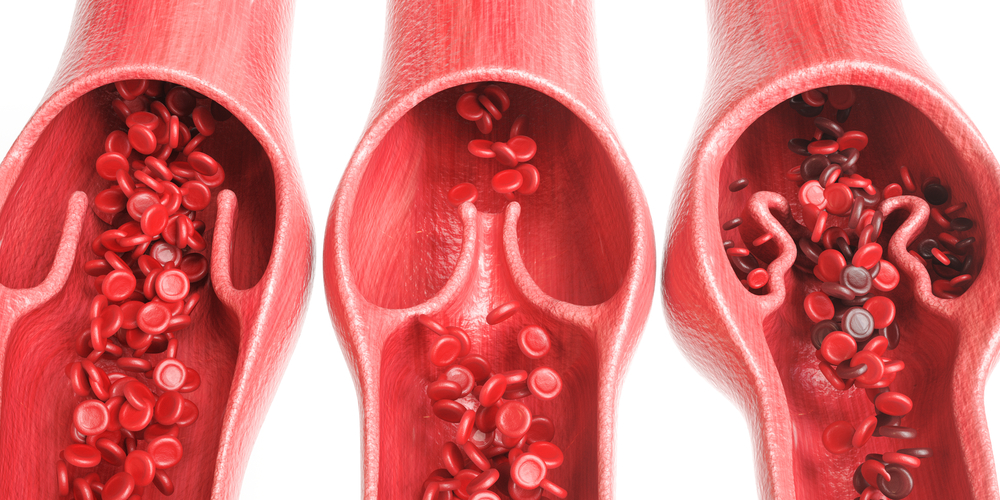 varicose veins of the pelvis and pelvic pain