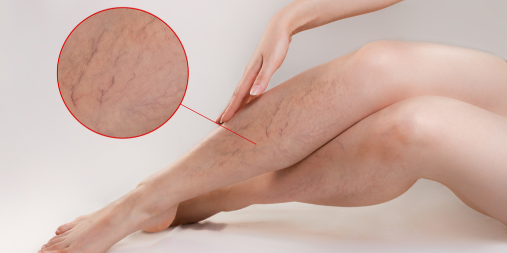 The concept of varicose disease and cosmetology. The woman gracefully crosses her legs with vascular stars,