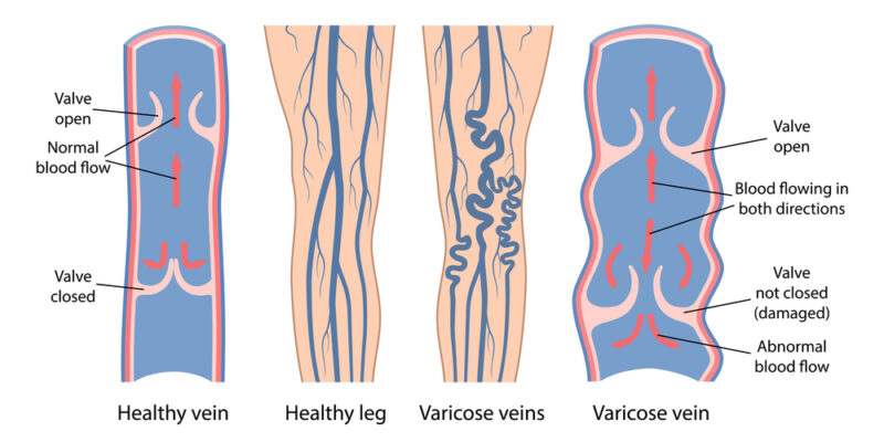 Venous Reflux Disease Vein Valve Insufficiency Varicose Veins Etiology