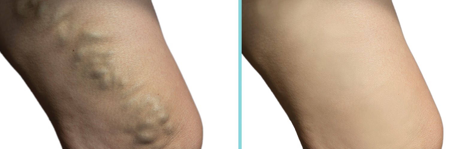 You Can Cure Your Legs and Rid Them of Bulging Ugly Veins!