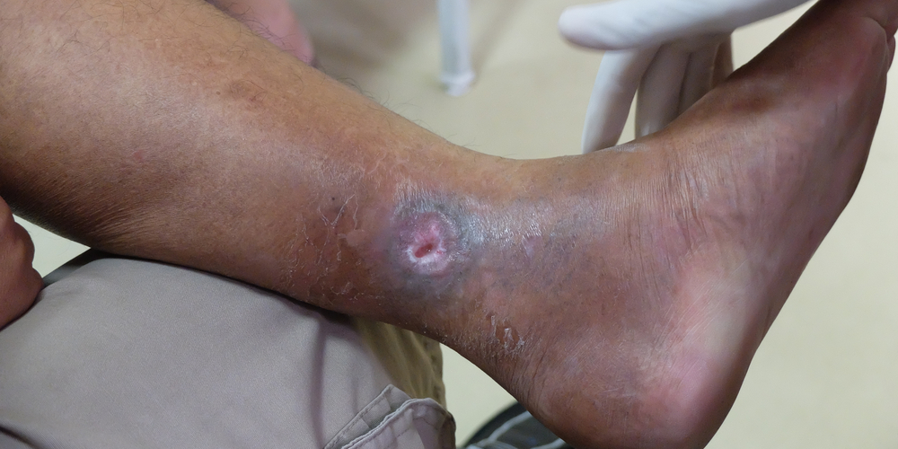 How to Treat Chronic Venous Insufficiency - The Vein Center of Maryland
